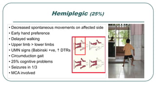Hemiplegic (25%)
• Decreased spontaneous movements on affected side
• Early hand preference
• Delayed walking
• Upper limb > lower limbs
• UMN signs (Babinski +ve, h DTRs
• Circumduction gait
• 25% cognitive problems
• Seizures in 1/3
• MCA involved
IAPUGTeachingslides2015-16
APHICAL OR ANATOMICAL
traplegia
gia
12
 