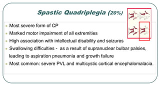 Spastic Quadriplegia (20%)
 Most severe form of CP
 Marked motor impairment of all extremities
 High association with intellectual disability and seizures
 Swallowing difficulties - as a result of supranuclear bulbar palsies,
leading to aspiration pneumonia and growth failure
 Most common: severe PVL and multicystic cortical encephalomalacia.
2015-16
ANATOMICAL
12
 