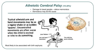 Athetotic Cerebral Palsy (15-20%)
• Damage to basal ganglia – status marmoratus
• Kernicterus may be the cause
PUGTeachingslides2015-16
d dystonia over several years.
basal ganglia
us
e the cause
22
Most likely to be associated with birth asphyxia.
 