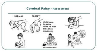 Cerebral Palsy - Assessment
 