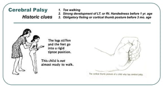 Cerebral Palsy
Historic clues
1. Toe walking
2. Strong development of LT. or Rt. Handedness before 1 yr. age
3. Obligatory fisting or cortical thumb posture before 3 mo. age
 
