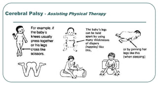 Cerebral Palsy - Assisting Physical Therapy
 
