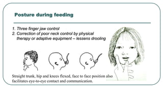 Posture during feeding
1. Three finger jaw control
2. Correction of poor neck control by physical
therapy or adaptive equipment – lessens drooling
Straight trunk, hip and knees flexed, face to face position also
facilitates eye-to-eye contact and communication.
 