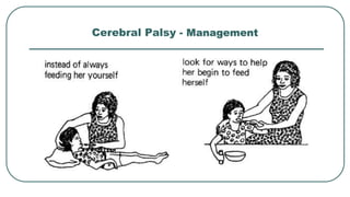 Cerebral Palsy - Management
 
