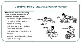 Cerebral Palsy - Assisting Physical Therapy
Whatever the child is doing (lying,
sitting, crawling, standing) try to
encourage positions so that:
• her head is straight up and down.
• her body is straight (not bent,
bowed, or twisted).
• both arms are straight and kept
away from the sides.
• both hands are in use, in front of
her eyes.
• she bears weight equally on both
sides of her body -
 