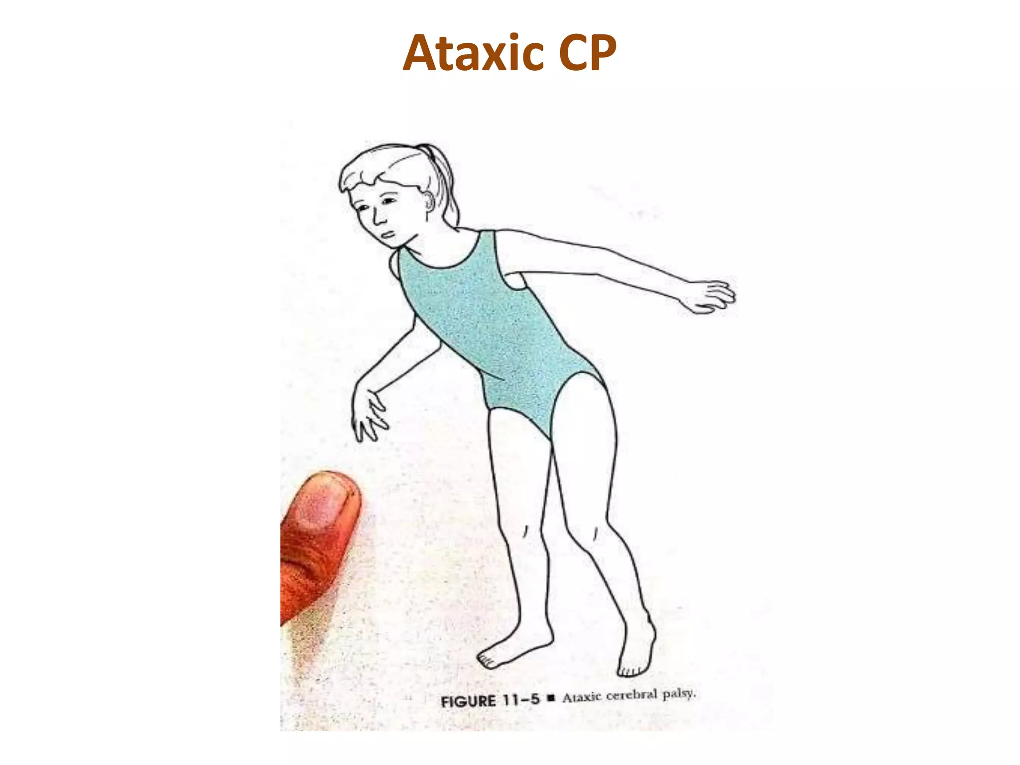 Cerebral palsy | PPTX