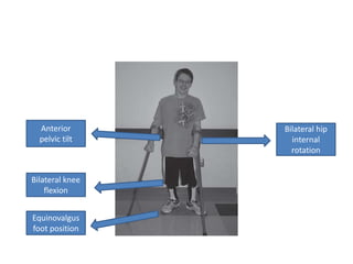 Anterior
pelvic tilt
Bilateral hip
internal
rotation
Bilateral knee
flexion
Equinovalgus
foot position
 