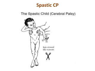 Spastic CP
 