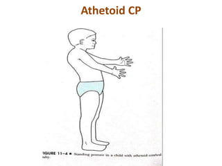 Athetoid CP
 