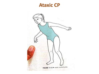 Ataxic CP
 