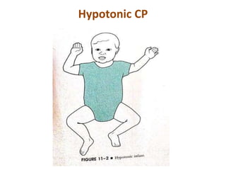 Hypotonic CP
 