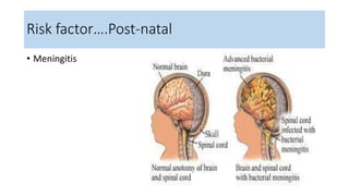 • Meningitis
Risk factor….Post-natal
 