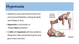 Hypotonia
• Hypotonia causes decreased muscle tone
and increased flexibility, making the body
seem floppy or limp.
• Hypertonia is also known as
"floppy infant syndrome".
• A child with hypotonia will have problems
lifting their limbs and performing fine and
gross motor activities.
 