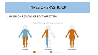 TYPES OF SPASTIC CP
• BASED ON REGIONS OF BODY AFFECTED-
 