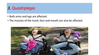 3. Quadriplegia
• Both arms and legs are affected.
• The muscles of the trunk, face and mouth can also be affected.
 