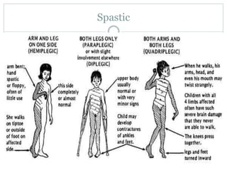 Spastic Posture cerebralpalsy For Medical Student And Healthcare.pptx