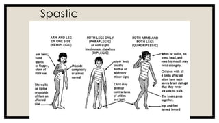 Comprehensive Overview of Cerebral Palsy: Causes, Symptoms, and ...