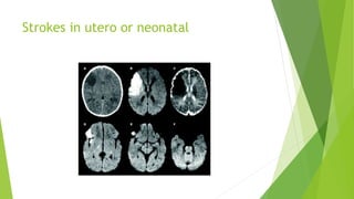 Strokes in utero or neonatal
 