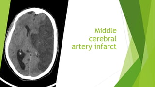 Middle
cerebral
artery infarct
 