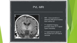 MRI and PVL
 