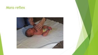 Moro reflex
 