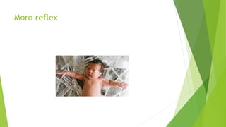 Moro reflex
 