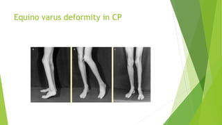 Equino varus deformity in CP
 