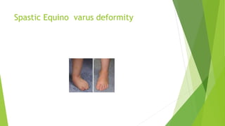 Spastic Equino varus deformity
 