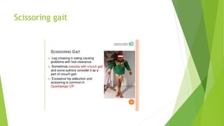 Scissoring gait
 