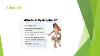 Athetoid
 