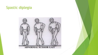 Spastic diplegia
 