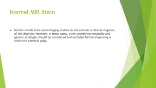 Normal MRI Brain
 Normal results from neuroimaging studies do not exclude a clinical diagnosis
of this disorder. However, in these cases, other underlying metabolic and
genetic etiologies should be considered and excluded before diagnosing a
child with cerebral palsy.
 