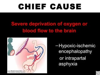 CHIEF CAUSE

Severe deprivation of oxygen or
    blood flow to the brain

                  – Hypoxic-ischemic
                    encephalopathy
                    or intrapartal
                    asphyxia
 