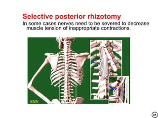 Selective posterior rhizotomy
In some cases nerves need to be severed to decrease
  muscle tension of inappropriate contractions.
 