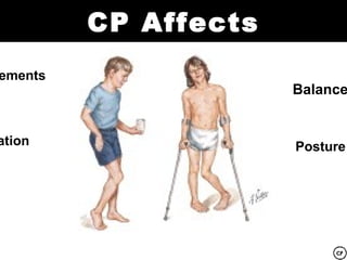 CP Affects
ements
                      Balance


ation                 Posture
 