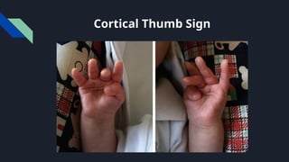 Cerebral Palsy approach, management (1).pptx