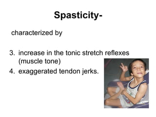 Spastic Posture Cerebral palsy - PG lecture for Orthopaedic Assessment and Management ...