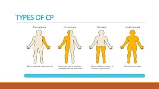 TYPES OF CP
 