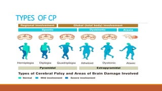 TYPES OF CP
 