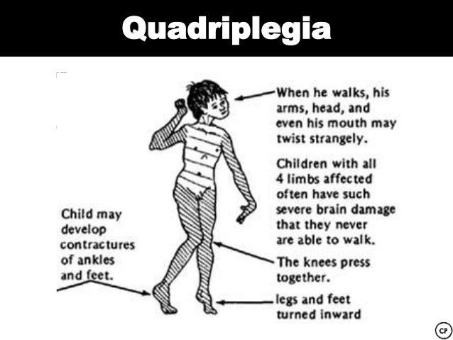 cerebral-palsy