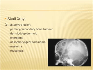 Skull Xray: 3.  osteolytic lesion; primary/secondary bone tumour. - dermiod/epidermoid - chordoma - nasopharyngeal carcinoma - myeloma - reticulosis  