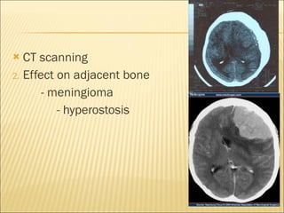 CT scanning Effect on adjacent bone - meningioma - hyperostosis 