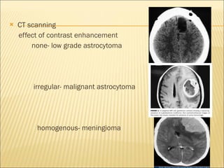 CT scanning effect of contrast enhancement none- low grade astrocytoma irregular- malignant astrocytoma homogenous- meningioma 