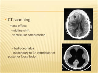 CT scanning mass effect: - midline shift - ventricular compression - hydrocephalus (secondary to 3 rd  ventricular of posterior fossa lesion 