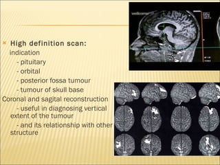 High definition scan: indication  - pituitary - orbital - posterior fossa tumour - tumour of skull base Coronal and sagital reconstruction - useful in diagnosing vertical extent of the tumour - and its relationship with other structure  