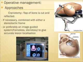 Operative management: Approaches  Craniotomy:- flap of bone is cut and reflected. - If necessary, combined with either a stereotactic frame  - or preferably an image guided system(frameless, steriotaxy) to give accurate lesion localisation 