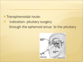 Transphenoidal route: indication- pituitary surgery through the sphenoid sinus  to the pituitary  