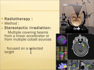 Radiotherapy :  Method :  Stereotactic irradiation: Multiple covering beams from a linear accelerator or from multiple cobalt sources focused on a selected target 