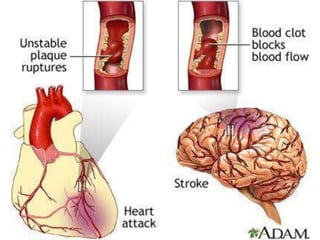 Cerebral vascular accident   stroke