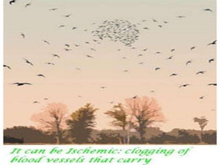 Cerebral vascular accident stroke